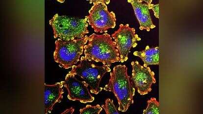 תאי מלנומה סרטניים. | ויקימדיה