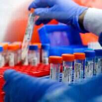 בדיקות קורונה. | AFP