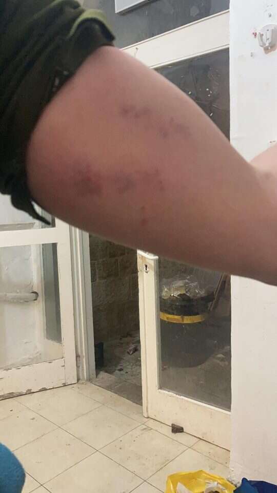 שטפי דם בזרועו של גוגנהיים, שגרמו לטענתו חוקרי המשטרה