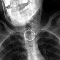 הרנטגן בו רואים את הפקק לפני שהוצא