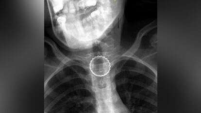 הרנטגן בו רואים את הפקק לפני שהוצא