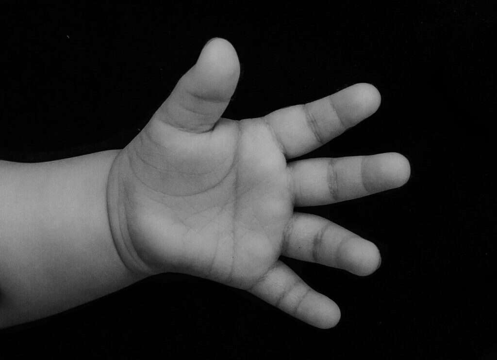 כף היד של פנינה דהוקרקר בת השנתיים - ילדה עם תסמונת דאון. הקו הישר על כף היד הוא הוא אחד הסימנים לילדים עם תסמונת דאון