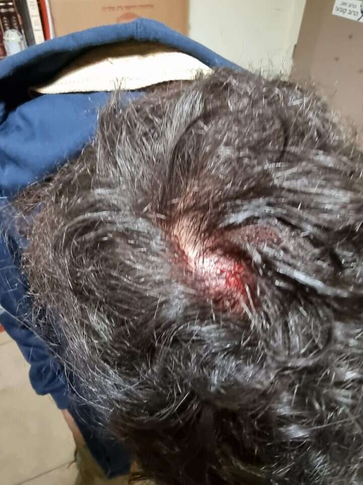 החבלה בראשו של הצעיר היהודי שהותקף. באדיבות המצלם