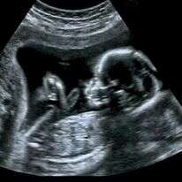 עובר באולטרסאונד. | שאטרסטוק עובר באולטרסאונד. | שאטרסטוק