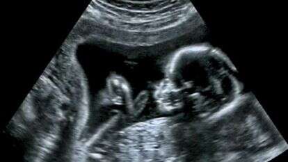 עובר באולטרסאונד. | שאטרסטוק עובר באולטרסאונד. | שאטרסטוק