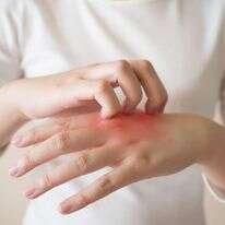 אלרגיה. | שאטרסטוק