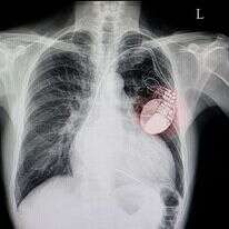 קוצב לב. | שאטרסטוק