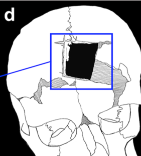 שרטוט חירור הראש. הקווים החדים מעידים שהניתוח נעשה בכלי אבן או מתכת עם קצה חד. שרטוט: המאמר מאת קלישר ואחרים, כתב העת המדעי PLOS ONE