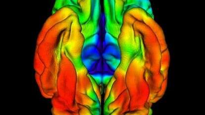 סריקת מוחו של חולה הדמנציה הקולומביאני, שמעידה על הצטברות טאו. | מסצ'וסטס ג'נרל הוספיטל