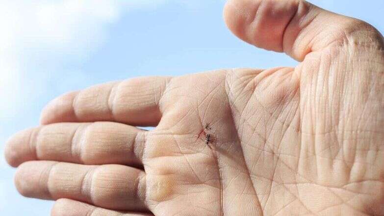 עקיצת יתוש. אילוסטרציה. | שאטרסטוק
