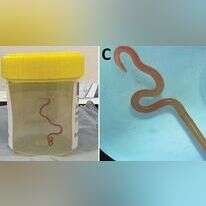 התולעת שהוצאה ממוחה של האישה. | EPA/Australian National University