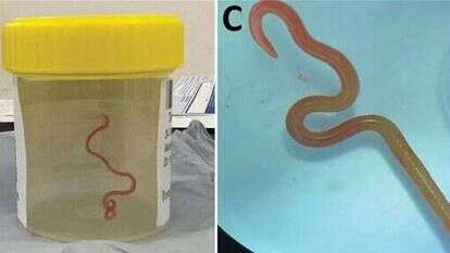 התולעת שהוצאה ממוחה של האישה. | EPA/Australian National University התולעת שהוצאה ממוחה של האישה. | EPA/Australian National University