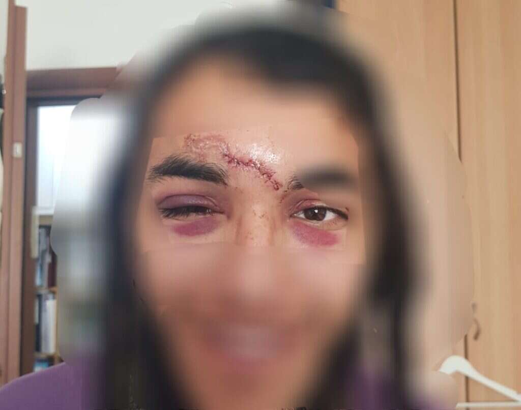 ח' שנפצע בפיגע האבנים בחווארה. ללא קרדיט