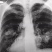 רנטגן של אדם עם סרטן בריאות.