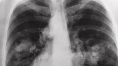 רנטגן של אדם עם סרטן בריאות.