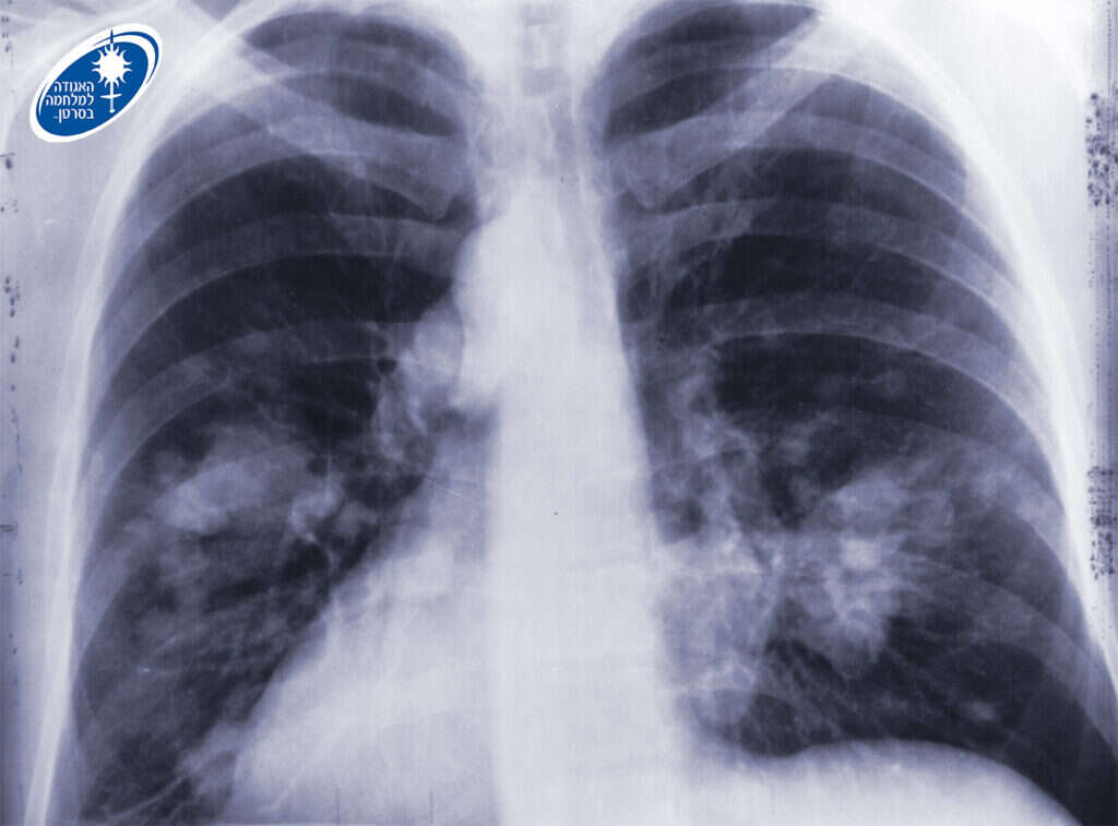 גם הפסקת עישון לאחר איבחון בסרטן ריאות עשויה להציל חיים. | רנטגן ובו ריאות אדם החולה בסרטן. באדיבות האגודה למלחמה בסרטן