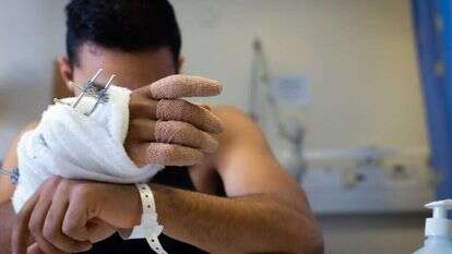 ידו הפצועה של תימור כהן־ששון, לפני כשנה. | אריק סולטן