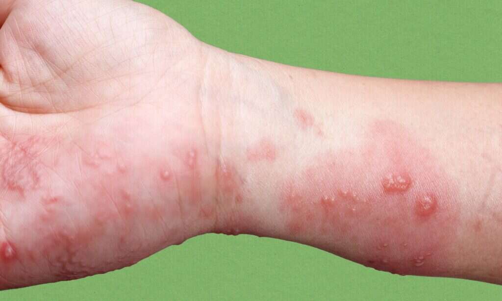 שלבקת חוגרת. | יח"צ שלבקת חוגרת. | יח"צ