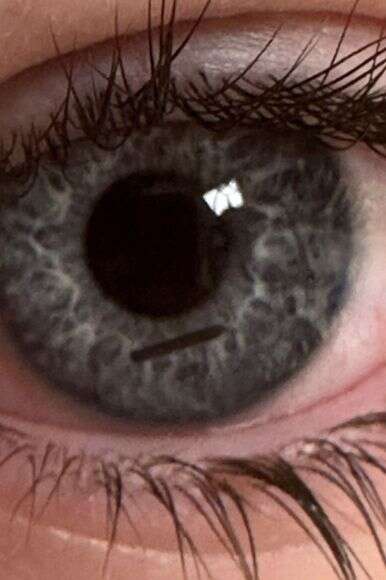 העין שנחבלה מעיפרון | דוברות שערי צדק העין שנחבלה מעיפרון | דוברות שערי צדק