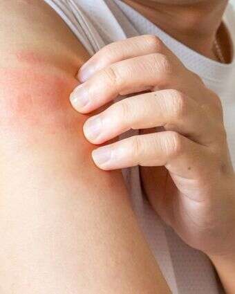 גירוד ובעיות עור | שאטרסטוק גירוד ובעיות עור | שאטרסטוק