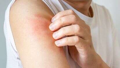 גירוד ובעיות עור | שאטרסטוק