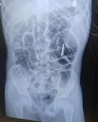 צילום גוף, בו נראות המספריים | שערי צדק צילום גוף, בו נראות המספריים | שערי צדק