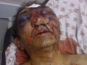 בארטיושר בלנו בבית החולים בארטיושר בלנו בבית החולים