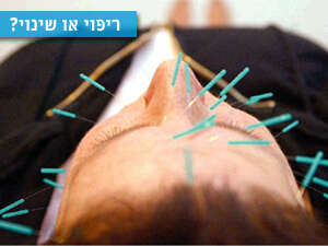 דיקור. טיפול משלים, לא אלטרנטיבי דיקור. טיפול משלים, לא אלטרנטיבי