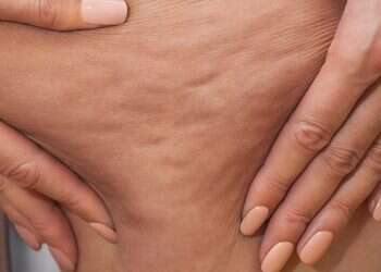 כל השיטות: המסת שומן בקור, בפיגמנטציה ובכתמי שמש