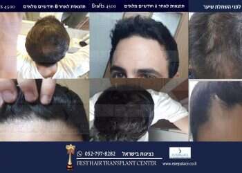 השתלת שיער בטורקיה: ד”ר נגיאן אקבס מסבירה ממה להיזהר
