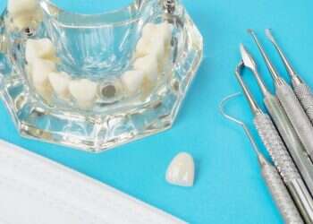 שיטת All On 4: חידוש בעולם השתלות השיניים