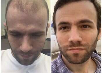 “קרחת זו לא גזירת גורל”