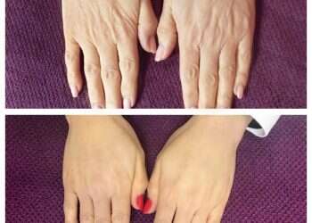 דשלי מציגה: ראדיאס RADIESSE