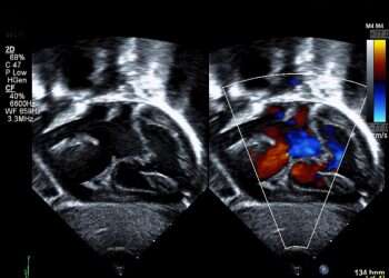 חוקרים ישראלים זיהו גן הגורם מומי לב קשים בילדים