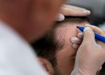 הישראלים חוזרים להשתלת שיער בטורקיה