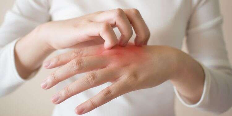 אלרגיה. צילום: שאטרסטוק סובלים מאלרגיית עור בעונת מעבר? טיפים לטיפול נכון