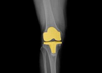 טיפול בכאבים לאחר החלפת ברך