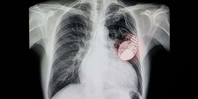 קוצב לב. צילום: שאטרסטוק רופאי נתניהו: "זו הסיבה שהזמנו את ראש הממשלה בדחיפות"