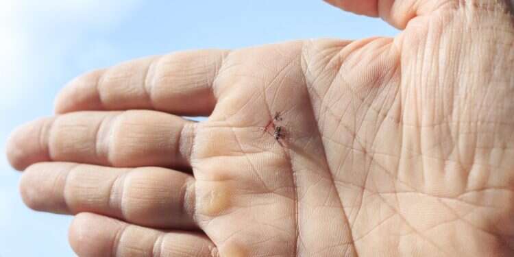 עקיצת יתוש. אילוסטרציה. צילום: שאטרסטוק יש מיליון סיבות שאלמנות לא ישנות בלילה – זו המעצבנת מכולן