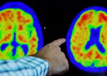 טיפול ניסיוני חדש נגד אלצהיימר מאט את המחלה