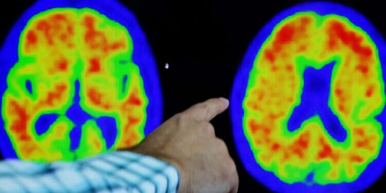 צילום: רויטרס טיפול ניסיוני חדש נגד אלצהיימר מאט את המחלה