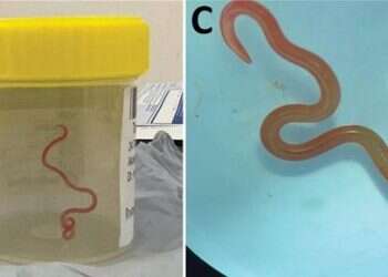 "המקרה הראשון אי פעם": רופאים מצאו תולעת טפילית חיה במוח של אישה 