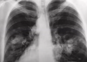 צילום רנטגן של אדם עם סרטן בריאות. צילום מסך מיוטיוב