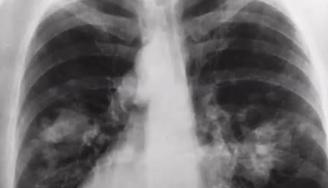 צילום רנטגן של אדם עם סרטן בריאות. צילום מסך מיוטיוב צילום רנטגן של אדם עם סרטן בריאות. צילום מסך מיוטיוב