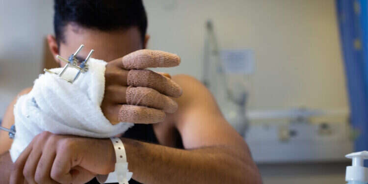 ידו הפצועה של תימור כהן־ששון, לפני כשנה. צילום: אריק סולטן